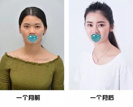 看我在三亞紅妝尚醫(yī)學(xué)美容做的自體軟骨隆鼻1個(gè)月恢復(fù)效果怎么樣