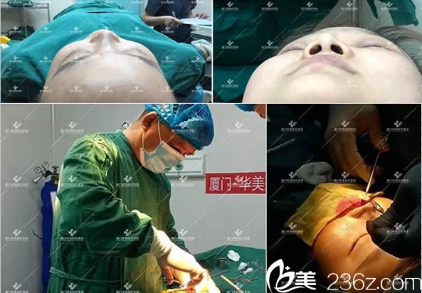 鼻綜合隆鼻手術(shù)過程圖