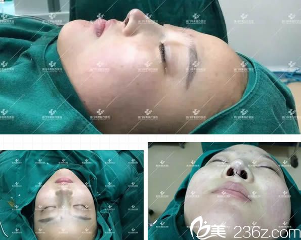 我了解過(guò)廈門華美和美萊及海峽的整形價(jià)格后，讓華美的賈虹醫(yī)生做了鼻綜合隆鼻