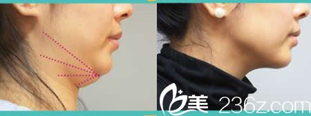 面部吸脂效果 面部吸脂效果