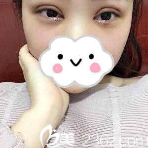 雙眼皮手術(shù)第三天 雙眼皮手術(shù)第三天