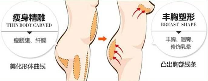 韓國(guó)快樂整形外科自體脂肪隆胸優(yōu)勢(shì)