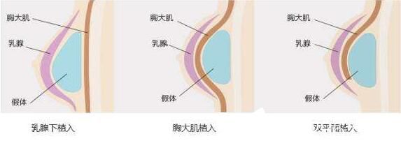 韓國(guó)快樂整形外科自體脂肪隆胸適合人群