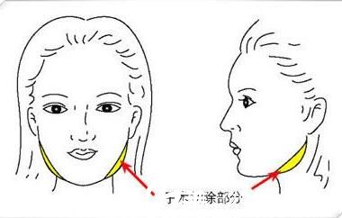 韓國(guó)快樂整形外科鄭哲賢面部輪廓手術(shù)方法 韓國(guó)快樂整形外科鄭哲賢面部輪廓手術(shù)方法