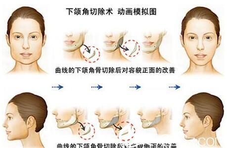 韓國(guó)快樂整形外科鄭哲賢面部輪廓手術(shù)方法優(yōu)缺點(diǎn) 韓國(guó)快樂整形外科鄭哲賢面部輪廓手術(shù)方法優(yōu)缺點(diǎn)