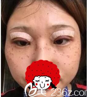 做完激光祛斑做雙眼皮 做完激光祛斑做雙眼皮