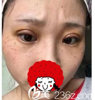 全切雙眼皮術(shù)后四天恢復(fù) 全切雙眼皮術(shù)后四天恢復(fù)