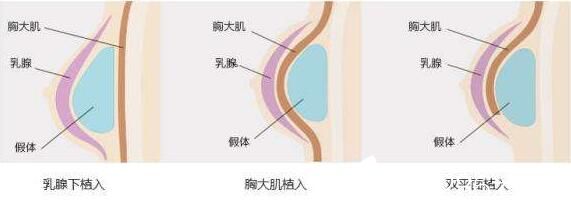 韓國(guó)快樂(lè)整形外科鐘泰元假體隆胸原理 韓國(guó)快樂(lè)整形外科鐘泰元假體隆胸原理