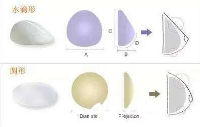 韓國(guó)快樂(lè)整形外科鐘泰元假體隆胸形狀 韓國(guó)快樂(lè)整形外科鐘泰元假體隆胸形狀