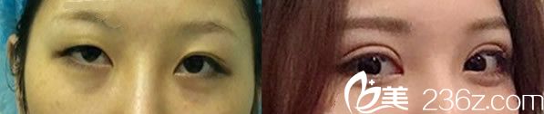 方暖碩雙眼皮全切手術(shù)代表案例 方暖碩雙眼皮全切手術(shù)代表案例