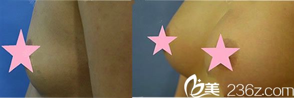 方暖碩自體豐胸真實案例