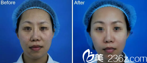 王雪艷主任做除皺案例 王雪艷主任做除皺案例