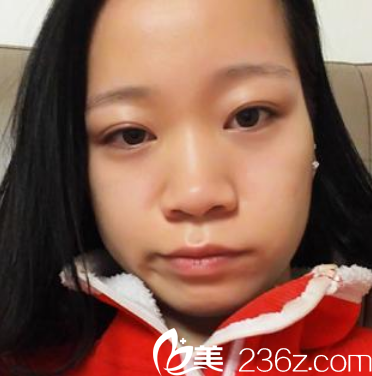 來廣州曙光整形醫(yī)院整形術(shù)前 來廣州曙光整形醫(yī)院整形術(shù)前