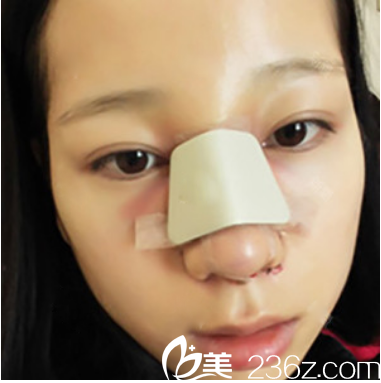 廣州曙光整形醫(yī)院范思軍隆鼻術(shù)后7天 廣州曙光整形醫(yī)院范思軍隆鼻術(shù)后7天