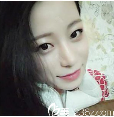 廣州曙光整形醫(yī)院范思軍鼻綜合隆鼻案例術(shù)后三個月 廣州曙光整形醫(yī)院范思軍鼻綜合隆鼻案例術(shù)后三個月