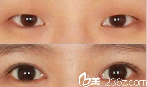 衡陽雅美醫(yī)療美容醫(yī)院雙眼皮案例效果圖