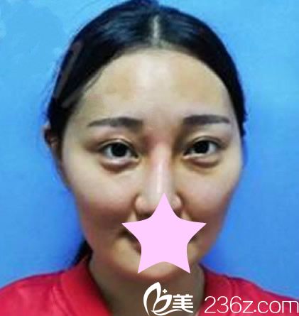 自體脂肪面部填充前