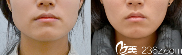 瘦臉對比案例 瘦臉對比案例