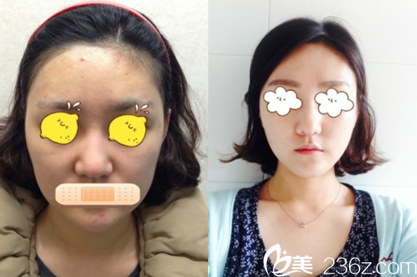 抗衰老技術(shù)前后對比 抗衰老技術(shù)前后對比