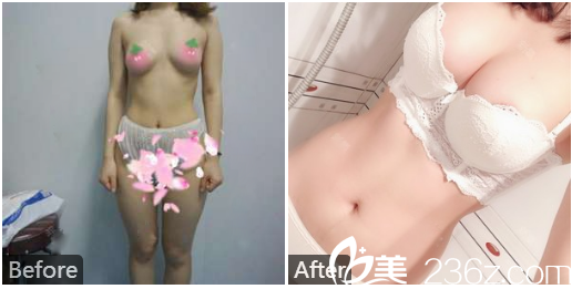 深圳曙光醫(yī)院整形美容科牟北平自體脂肪隆胸案例 深圳曙光醫(yī)院整形美容科牟北平自體脂肪隆胸案例