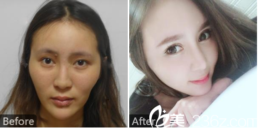 深圳曙光醫(yī)院整形美容科牟北平自體脂肪面部填充案例 深圳曙光醫(yī)院整形美容科牟北平自體脂肪面部填充案例