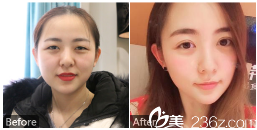 深圳曙光整形醫(yī)院<!--<i data=20240703-sp></i>-->切開(kāi)雙眼皮案例 深圳曙光整形醫(yī)院<!--<i data=20240703-sp></i>-->切開(kāi)雙眼皮案例