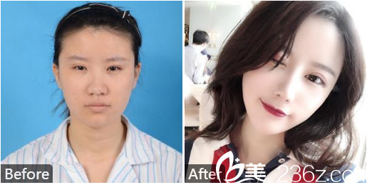 深圳曙光醫(yī)院整形美容科<!--<i data=20240703-sp></i>-->鼻部整形案例 深圳曙光醫(yī)院整形美容科<!--<i data=20240703-sp></i>-->鼻部整形案例