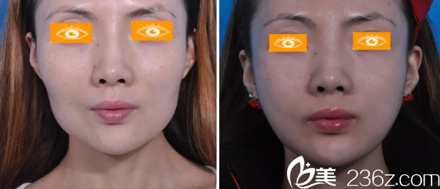 深圳曙光醫(yī)院整形美容科河?xùn)|鎬下頜角整形案例 深圳曙光醫(yī)院整形美容科河?xùn)|鎬下頜角整形案例