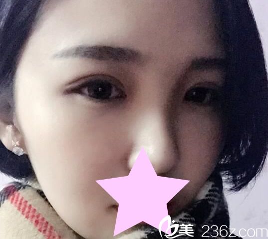 看韓國TheOne整形醫(yī)院如何將單眼皮變成雙眼皮，分享我全切雙眼皮的恢復(fù)過程