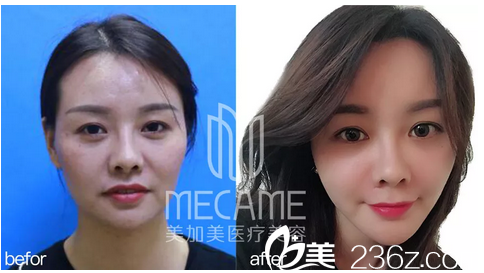 深圳美加美陳群自體脂肪面部填充案例前后對比圖 深圳美加美陳群自體脂肪面部填充案例前后對比圖