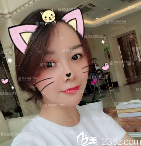 深圳美加美陳群自體脂肪全臉填充術(shù)后半個月自拍 深圳美加美陳群自體脂肪全臉填充術(shù)后半個月自拍