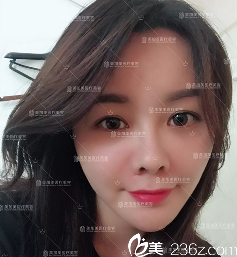 只是找深圳美加美整形醫(yī)院陳群院長(zhǎng)做了自體脂肪面部填充就讓我嫩如嬰兒美成仙了