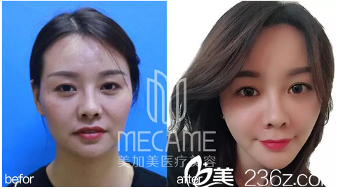 深圳美加美整形醫(yī)院陳群自體脂肪填充對(duì)比案例 深圳美加美整形醫(yī)院陳群自體脂肪填充對(duì)比案例