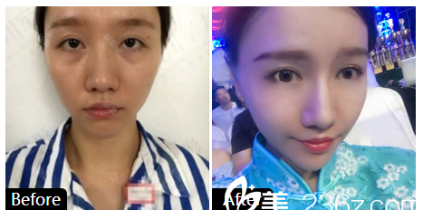 深圳美加美整形醫(yī)院陳群隆鼻案例前后對(duì)比 深圳美加美整形醫(yī)院陳群隆鼻案例前后對(duì)比