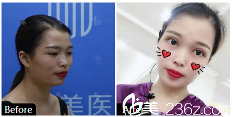 深圳美加美整形醫(yī)院陳群雙眼皮案例 深圳美加美整形醫(yī)院陳群雙眼皮案例