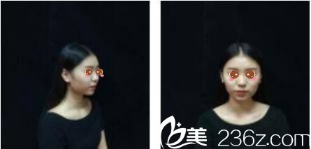 韓國(guó)樂(lè)世里L(fēng)UXELL整形醫(yī)院金弘承面部埋線提升真人案例術(shù)前照 韓國(guó)樂(lè)世里L(fēng)UXELL整形醫(yī)院金弘承面部埋線提升真人案例術(shù)前照