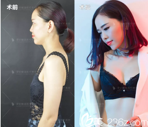 深圳雅涵整形醫(yī)院高山隆胸案例對比圖