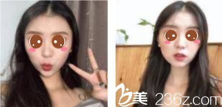 韓國(guó)樂(lè)世里L(fēng)UXELL整形醫(yī)院金弘承面部埋線提升真人案例術(shù)后十五天 韓國(guó)樂(lè)世里L(fēng)UXELL整形醫(yī)院金弘承面部埋線提升真人案例術(shù)后十五天