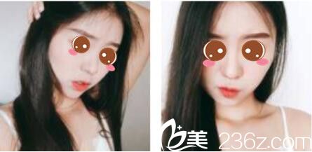 韓國(guó)樂(lè)世里L(fēng)UXELL整形醫(yī)院金弘承面部埋線提升真人案例術(shù)后一個(gè)月 韓國(guó)樂(lè)世里L(fēng)UXELL整形醫(yī)院金弘承面部埋線提升真人案例術(shù)后一個(gè)月