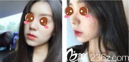 韓國(guó)樂(lè)世里L(fēng)UXELL整形醫(yī)院金弘承面部埋線提升真人案例術(shù)后三個(gè)月 韓國(guó)樂(lè)世里L(fēng)UXELL整形醫(yī)院金弘承面部埋線提升真人案例術(shù)后三個(gè)月