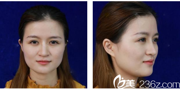 廣州韓妃整形醫(yī)院陳坦線雕埋線提升術(shù)前 廣州韓妃整形醫(yī)院陳坦線雕埋線提升術(shù)前