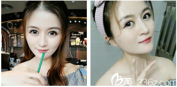 廣州韓妃陳坦做的線雕案例術(shù)后一個(gè)月 廣州韓妃陳坦做的線雕案例術(shù)后一個(gè)月