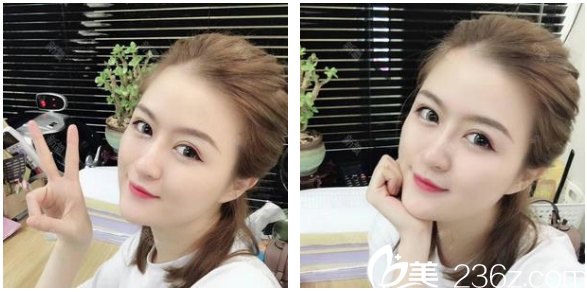 廣州韓妃陳坦線雕+玻尿酸填充+瘦臉案例 廣州韓妃陳坦線雕+玻尿酸填充+瘦臉案例