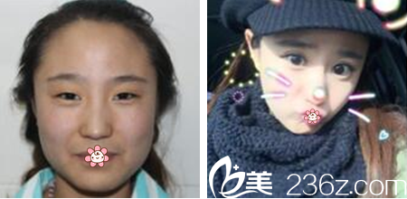 韓國(guó)GIO整形外科車知?jiǎng)熳鲭p眼皮效果好不好 韓國(guó)GIO整形外科車知?jiǎng)熳鲭p眼皮效果好不好