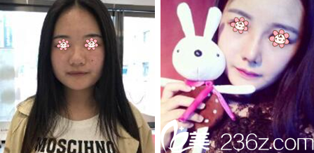 韓國GIO整形外科李勝勛隆鼻效果怎么樣 韓國GIO整形外科李勝勛隆鼻效果怎么樣