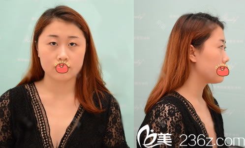 在杭州瑞麗做眼鼻和脂肪填充前 在杭州瑞麗做眼鼻和脂肪填充前