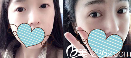 太原時光整形雙眼皮失敗修復(fù)案例效果圖