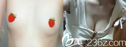 太原時光整形隆胸前后效果對比圖