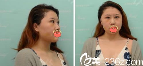 在杭州瑞麗做眼鼻脂肪填充4天效果 在杭州瑞麗做眼鼻脂肪填充4天效果