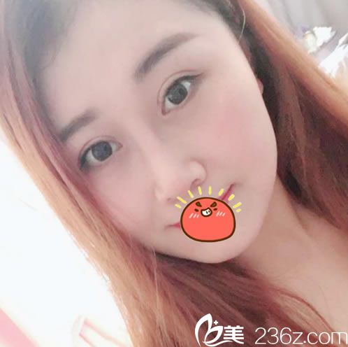 上午面診杭州瑞麗整形醫(yī)院王俞明,下午就做了雙眼皮+鼻綜合隆鼻+自體脂肪填充手術(shù)